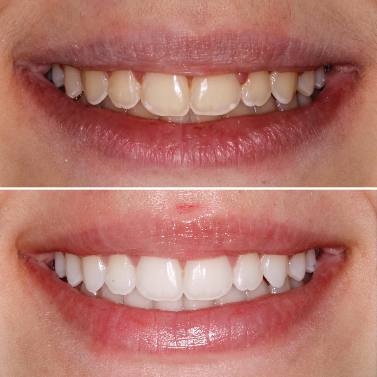 Antes e depois de tratamento ortodôntico — caso 1