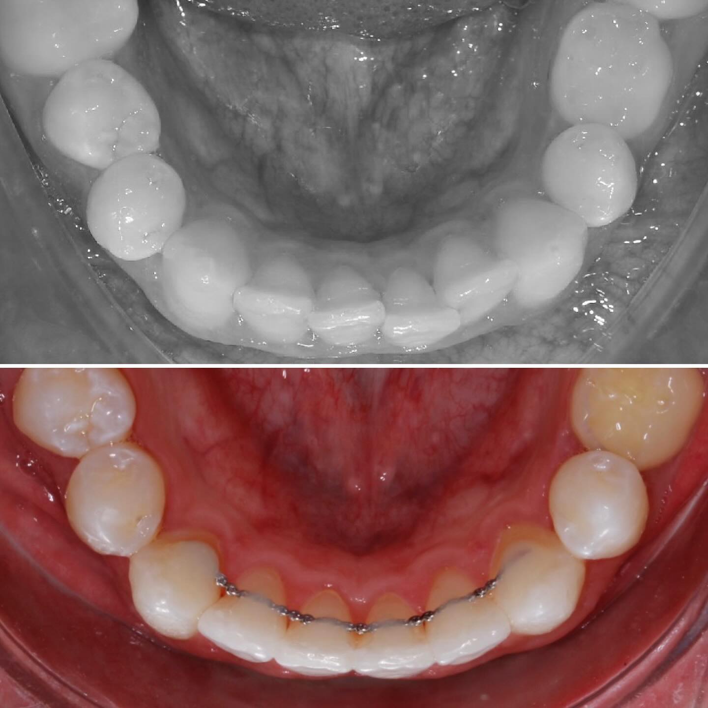 Antes e depois de tratamento ortodôntico — caso 2